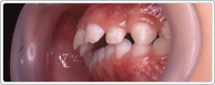 幼児期の歯列矯正前