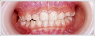 歯列育形成継続中の写真