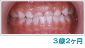 歯列育形成による反対咬合の経過 ３歳２ヶ月