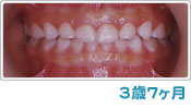 歯列育形成による反対咬合の経過 ３歳７ヶ月