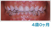 歯列育形成による反対咬合の経過 ４歳０ヶ月